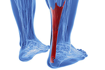 Achilles tendonitis treatment in the Arlington, TX 76013 area