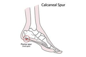 Stretches for Heel Spurs