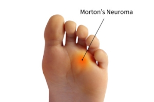 Essential Insights Into Morton&#039;s Neuroma