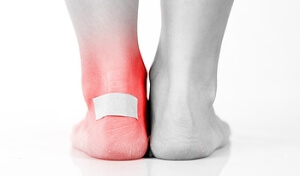 Hikers and Blisters