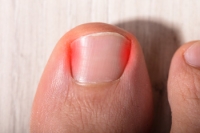 Surgery for Ingrown Nails