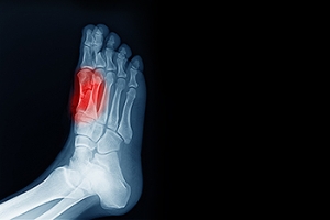 What Is Sesamoiditis and What Does It Have to Do With My Feet?