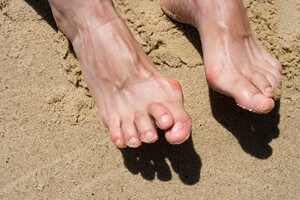 Hammertoe May Be Considered To Be A Muscle Imbalance