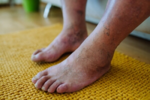 Infection From Diabetic Foot Ulcers