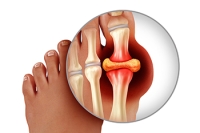 Gout and Its Causes