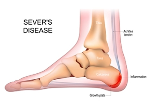 Causes and Risk Factors of Sever’s Disease