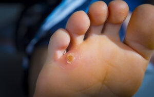 Caring For Corns on the Feet