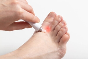 Types of Athlete&#039;s Foot