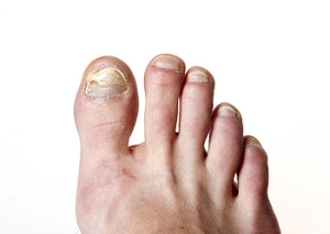 Toenail Fungus and Dietary Habits