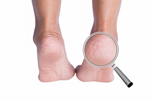 Healing Cracked Heels