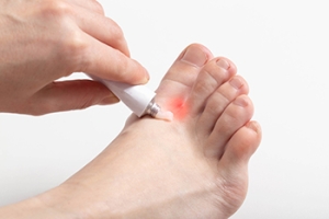 Types of Athlete&#039;s Foot