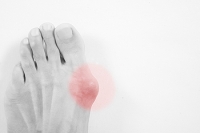 Can Bunions Develop as a Result of Having Arthritis?