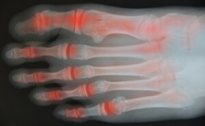 Treating Arthritis