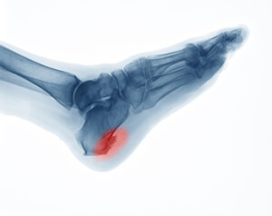 Relieving Heel Spur Pain by Stretching