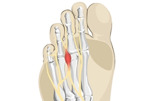 Irritated Nerve Between the Toes