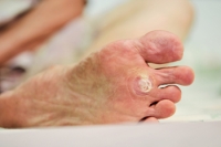 When to Seek Help For Plantar Warts