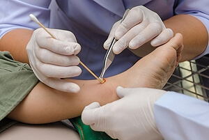 What are Foot Ulcers?